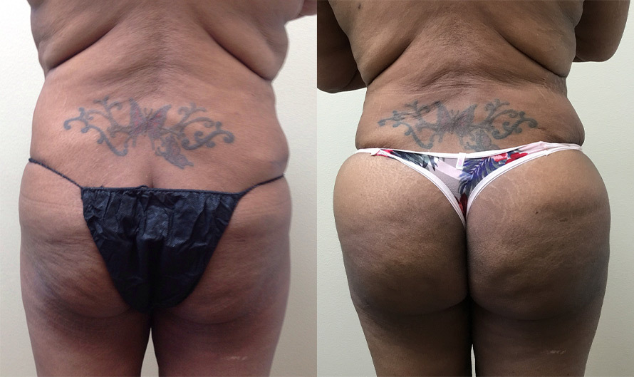 Surgery brazilian butt lift Brazilian Butt