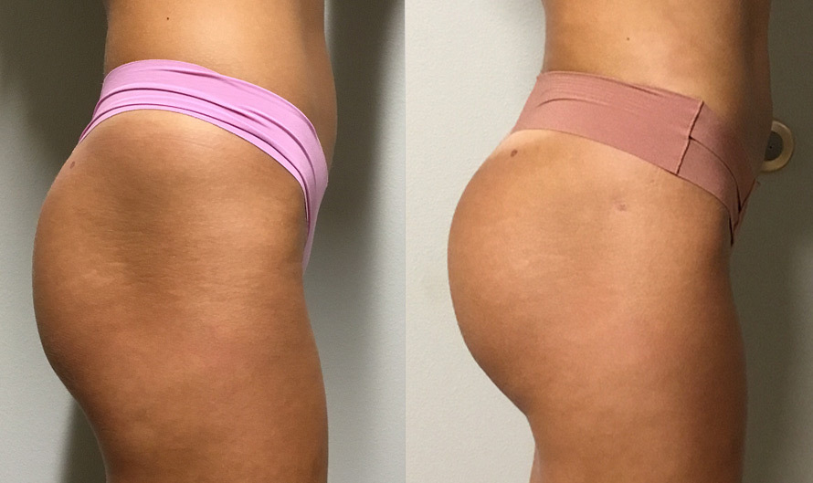 Brazilian Butt Lift Bradenton, FL - BBL Surgery Sarasota | Dr. Lacerna