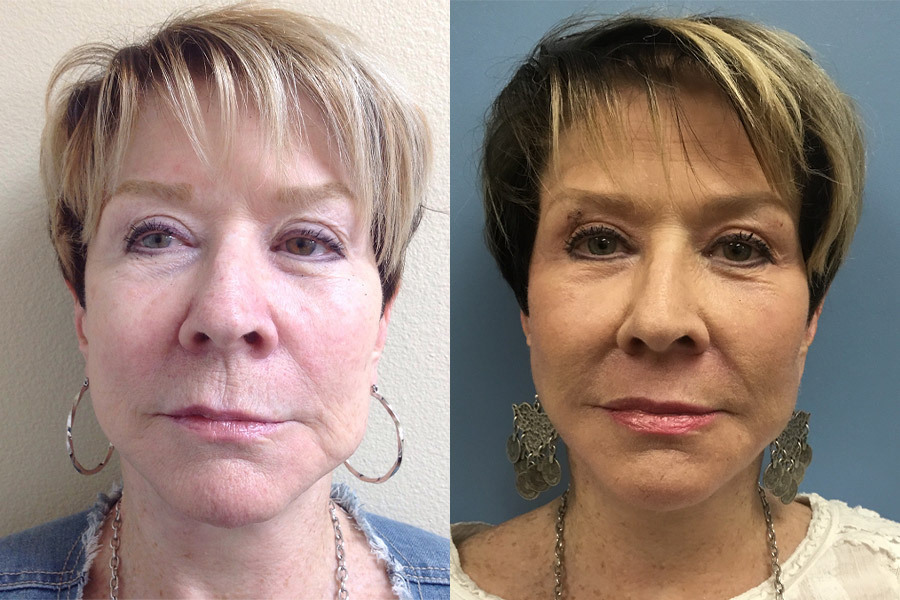 LM-JPLASTY-FACE-AND-NECK-WITH-RESURFACING-PERIORBITAL-AND-PERIORAL-AFTER-1