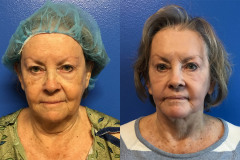 BA-FACE.NECK-WITH-RENUVION-RESURFACING-AFTER