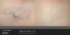 Palomar Laser Before After Photos