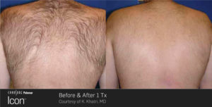 Back Hair Removal Patient Photos