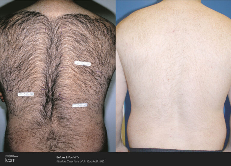 Laser hair Removal Before and After Photos