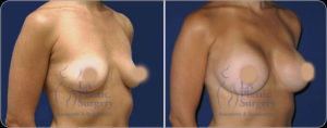 Dr. Lucerna Breast Reconstruction