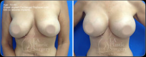 Breast Surgery Before and After Photos