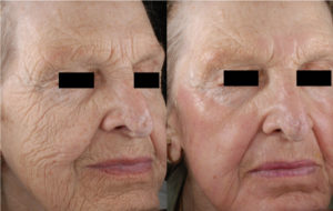 Laser Skin Resurfacing for Bradenton &#038; Sarasota, FL