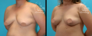Breast Lift Patient Photos