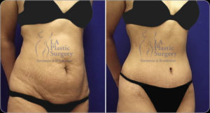 Liposuction for Bradenton &#038; Sarasota, FL
