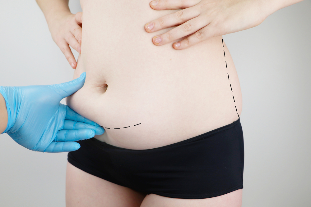 HOW MUCH IS A FULL TUMMY TUCK?