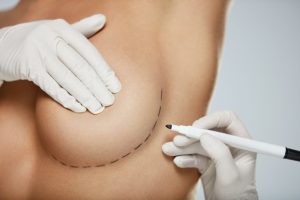 Breast Implants Bradenton & Sarasota FL