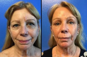 Preview Before and After Minimally Invasive Brow Lift Bradenton & Sarasota FL