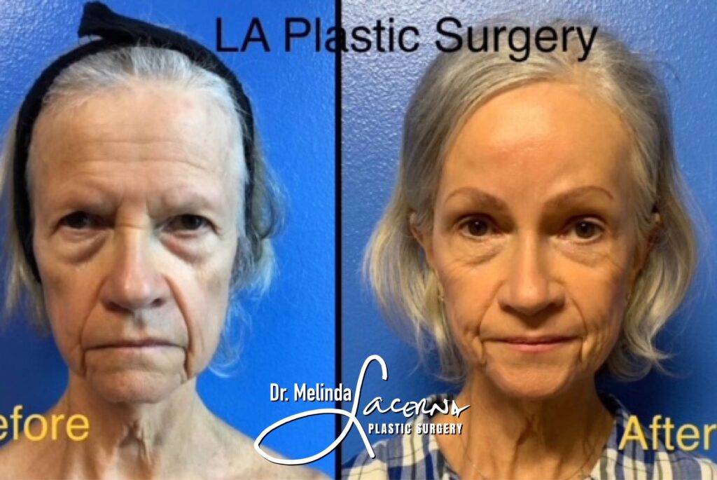 Brow Lift LA Plastic Surgery