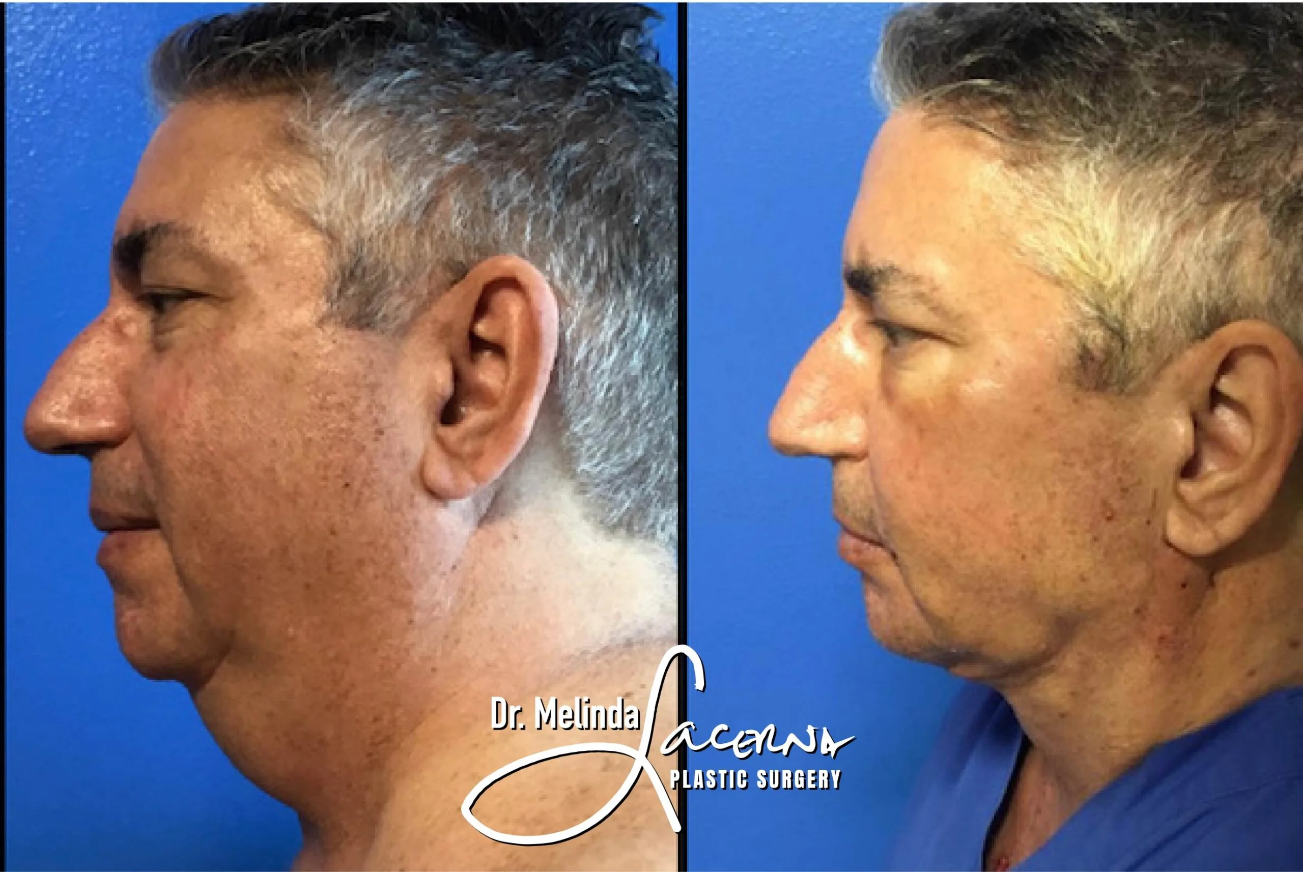 Facelift 1.1