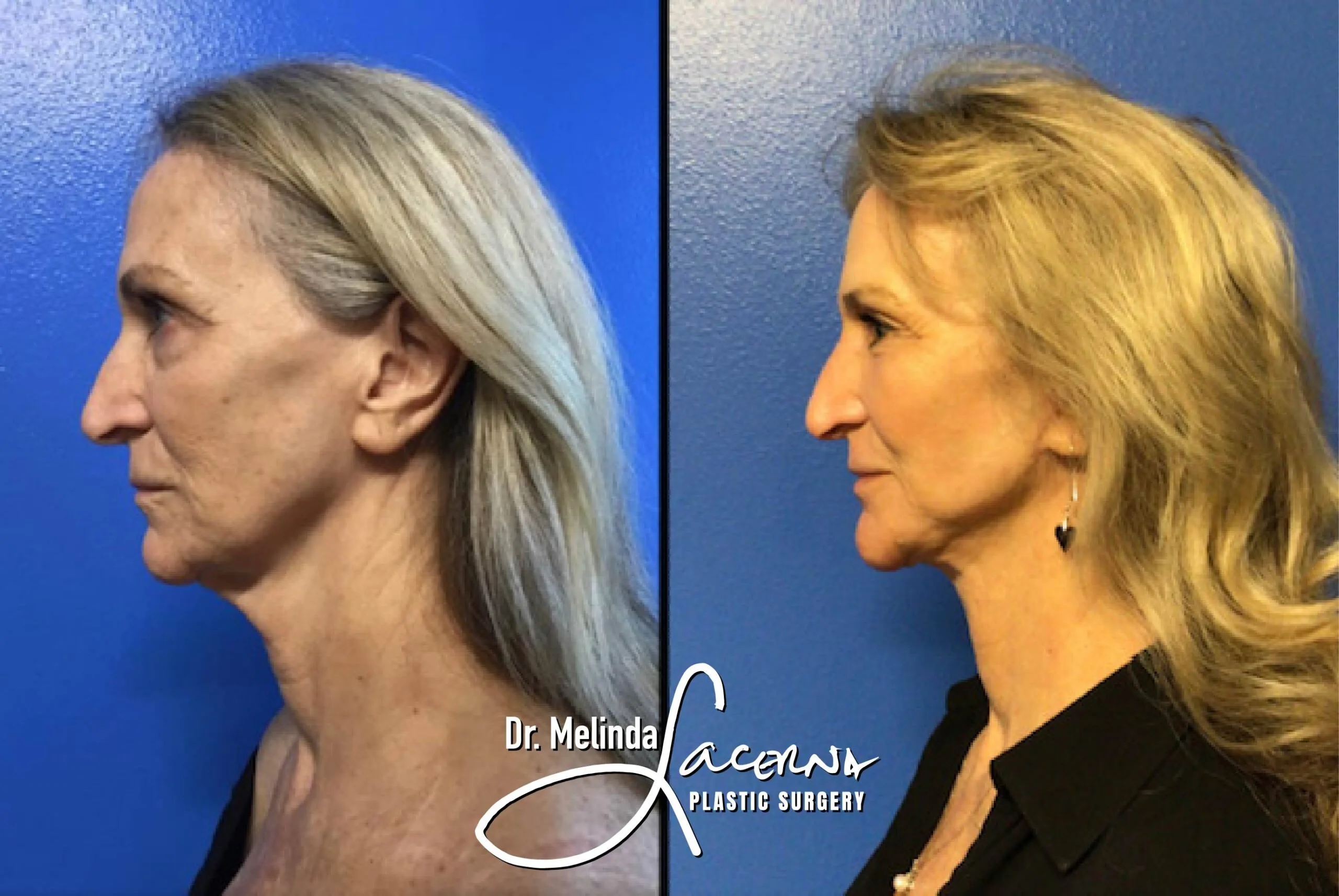Facelift 18.1