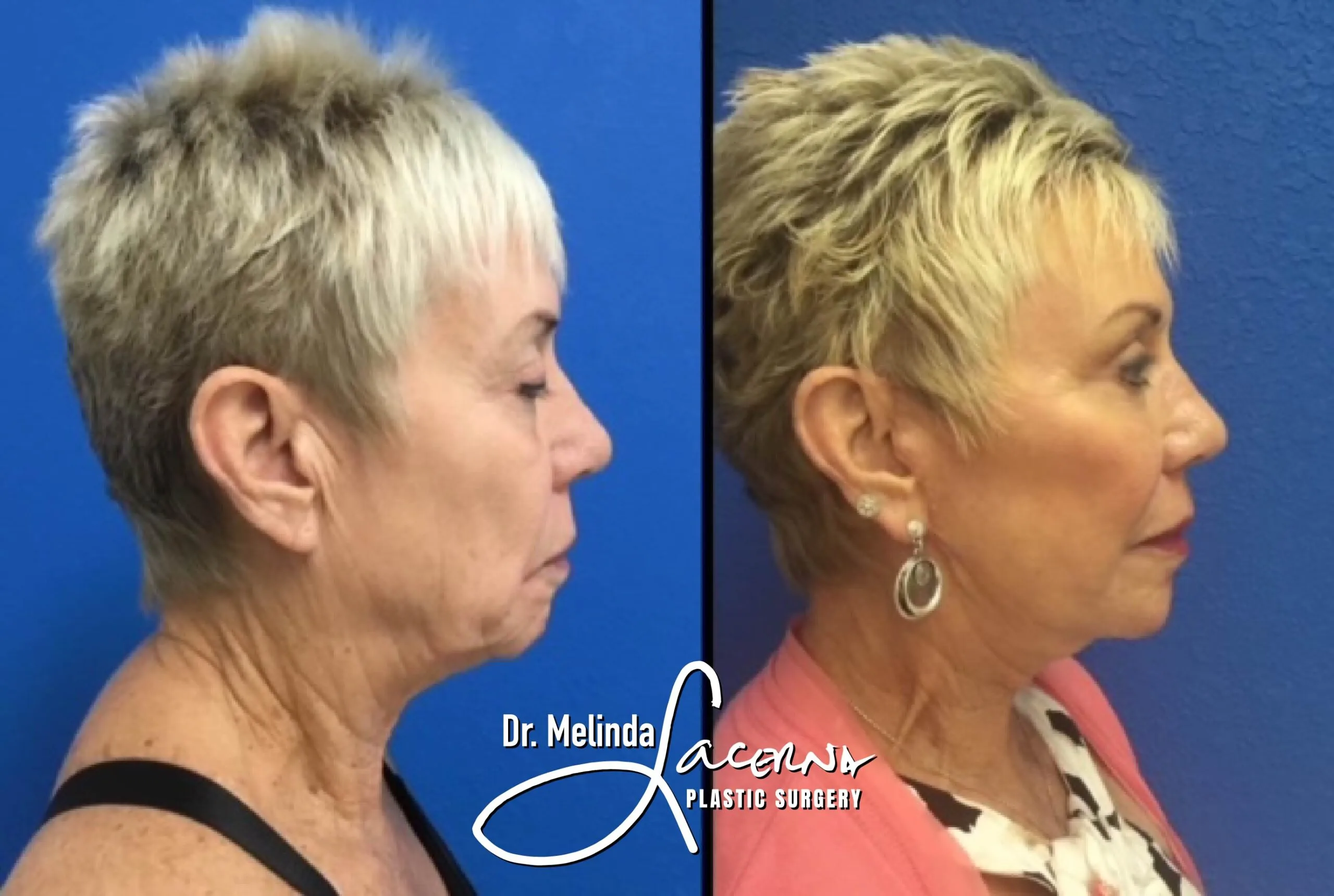Facelift 6.1