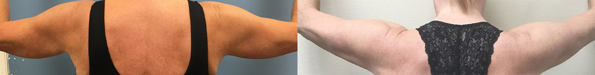 MT-RENUVION-ARMS-POSTERIOR-AFTER