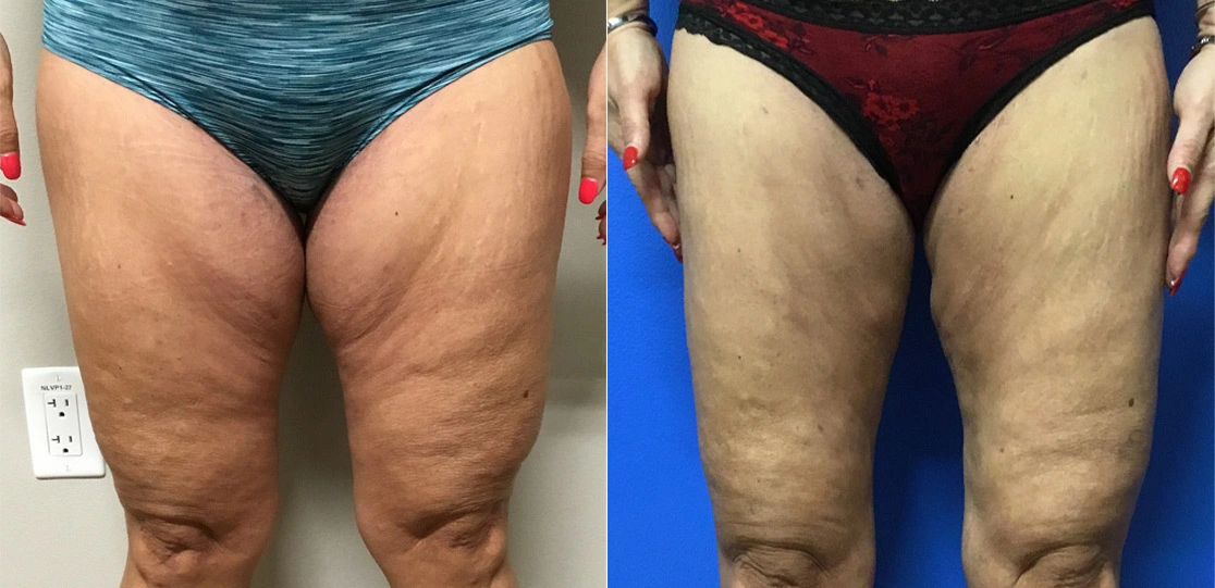 lc-thighs