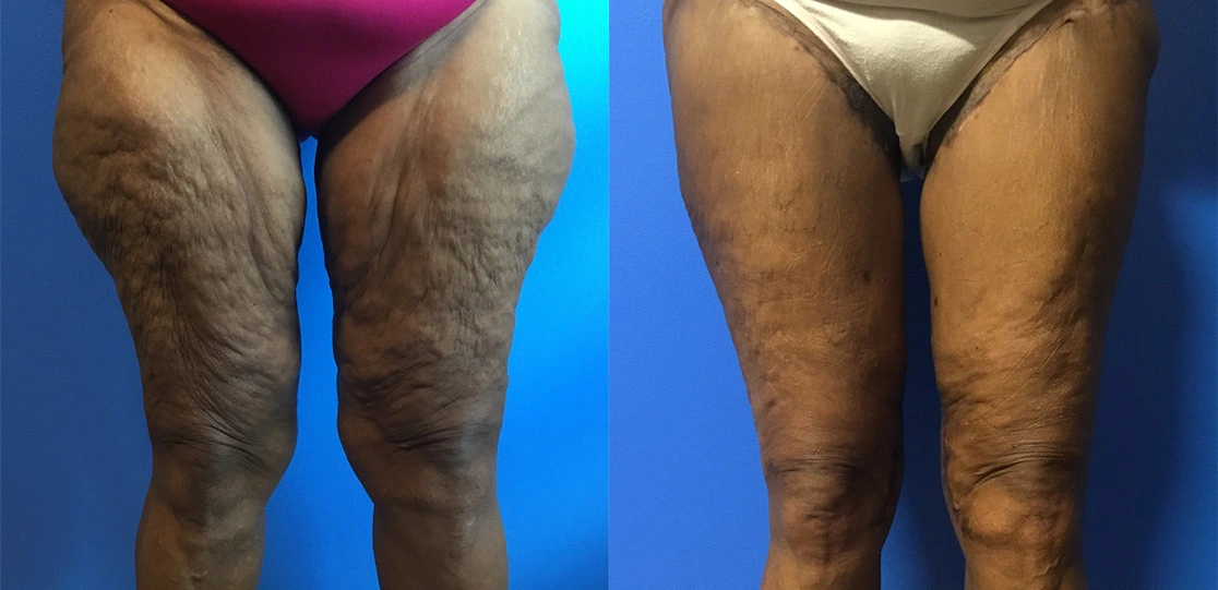 rt-thighs