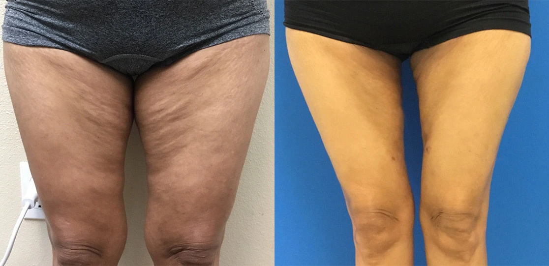 sa-thighs