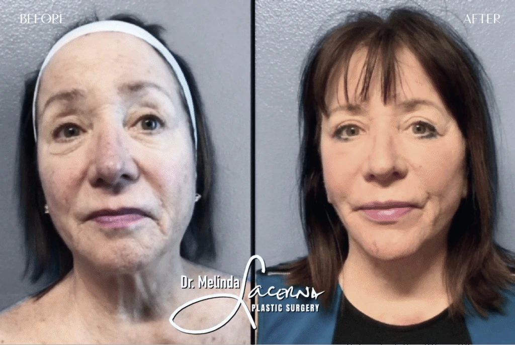 Before & After Gallery Facelift Banner