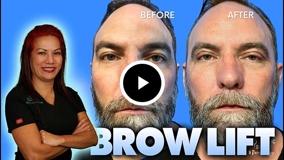 Male Brow Lift Patient Video Thumbnail