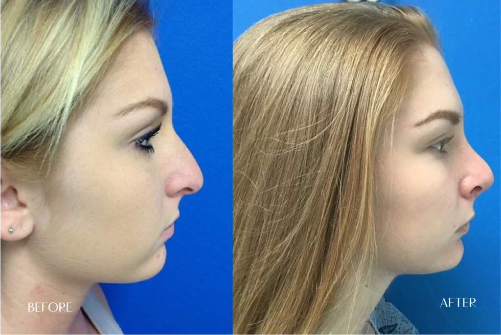 Rhinoplasty: Before and After Gallery
