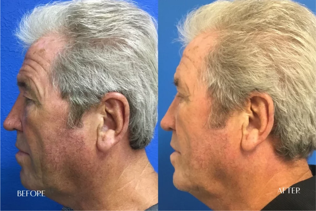 Rhinoplasty: Before and After Gallery