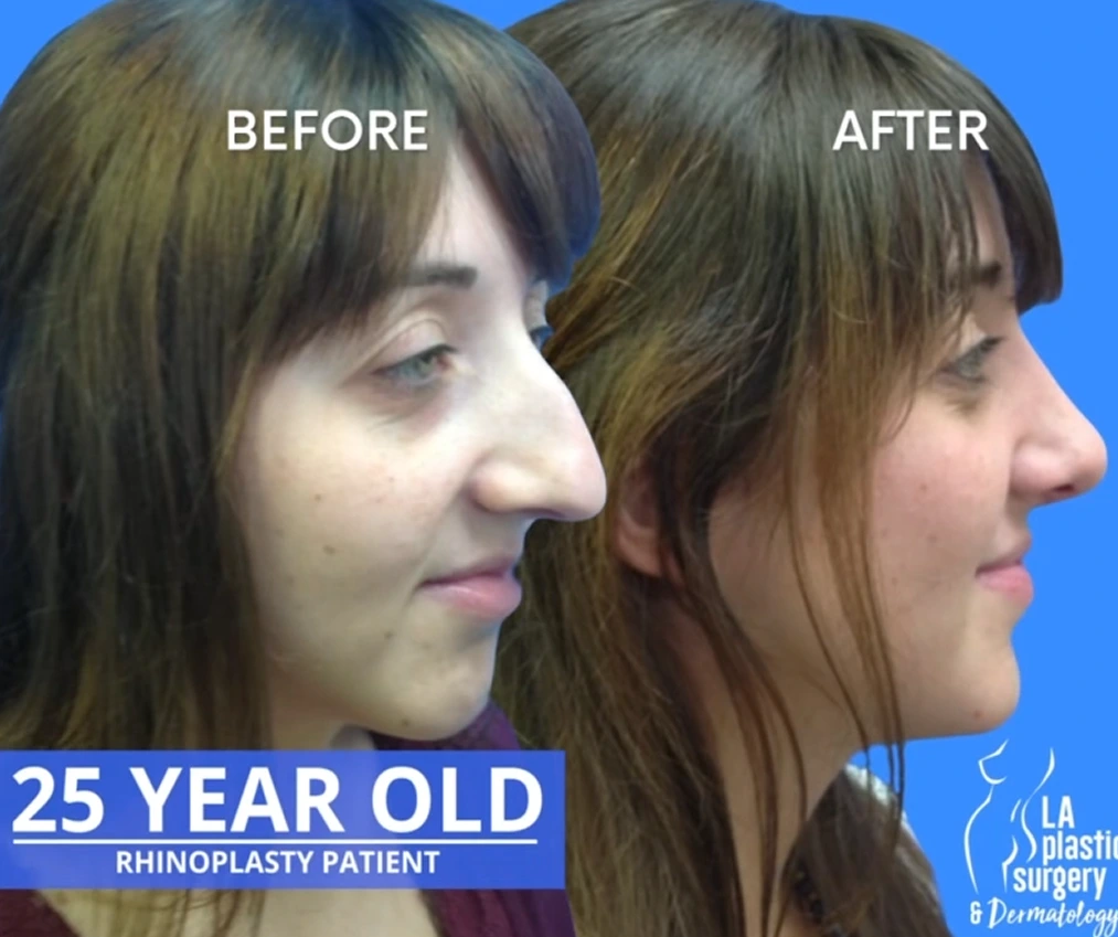 Rhinoplasty in Bradenton and Sarasota, FL BgRhinoplasty in Bradenton and Sarasota, FL Bg