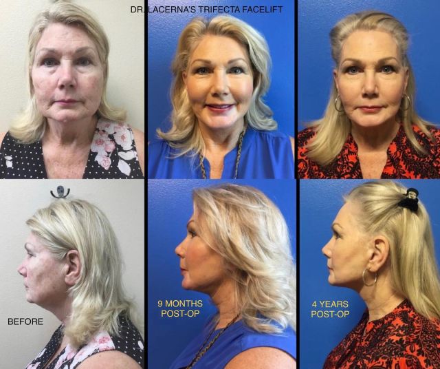 Dr. Lacerna’s Trifecta facelift lasts and lasts…as shown by our beautiful patient 4 years post op! Don’t you think she looks prettier at 72 than 68?
#drlacerna #laplasticsurgery #faceliftspecialist #renuvionneck #renuvionplasmaresurfacing