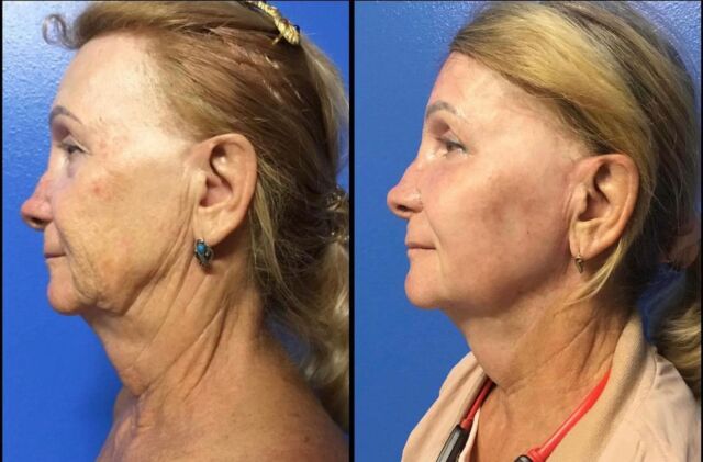 The power of Renuvion plasma resurfacing of the face and neck plus EXO ELIXIR exosomes! No skin removal was performed on our beautiful 68 y.o.patient!  #drlacerna  #laplasticsurgery #scarlessfacelift #scarlessnecklift #renuvionplasmaresurfacing #exoelixir #exosomes